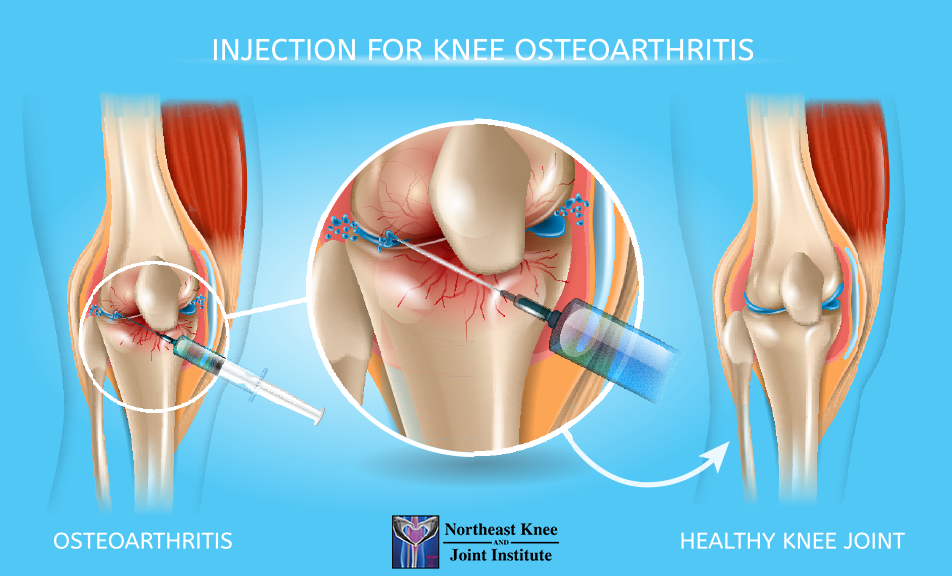 knee gel injections cost