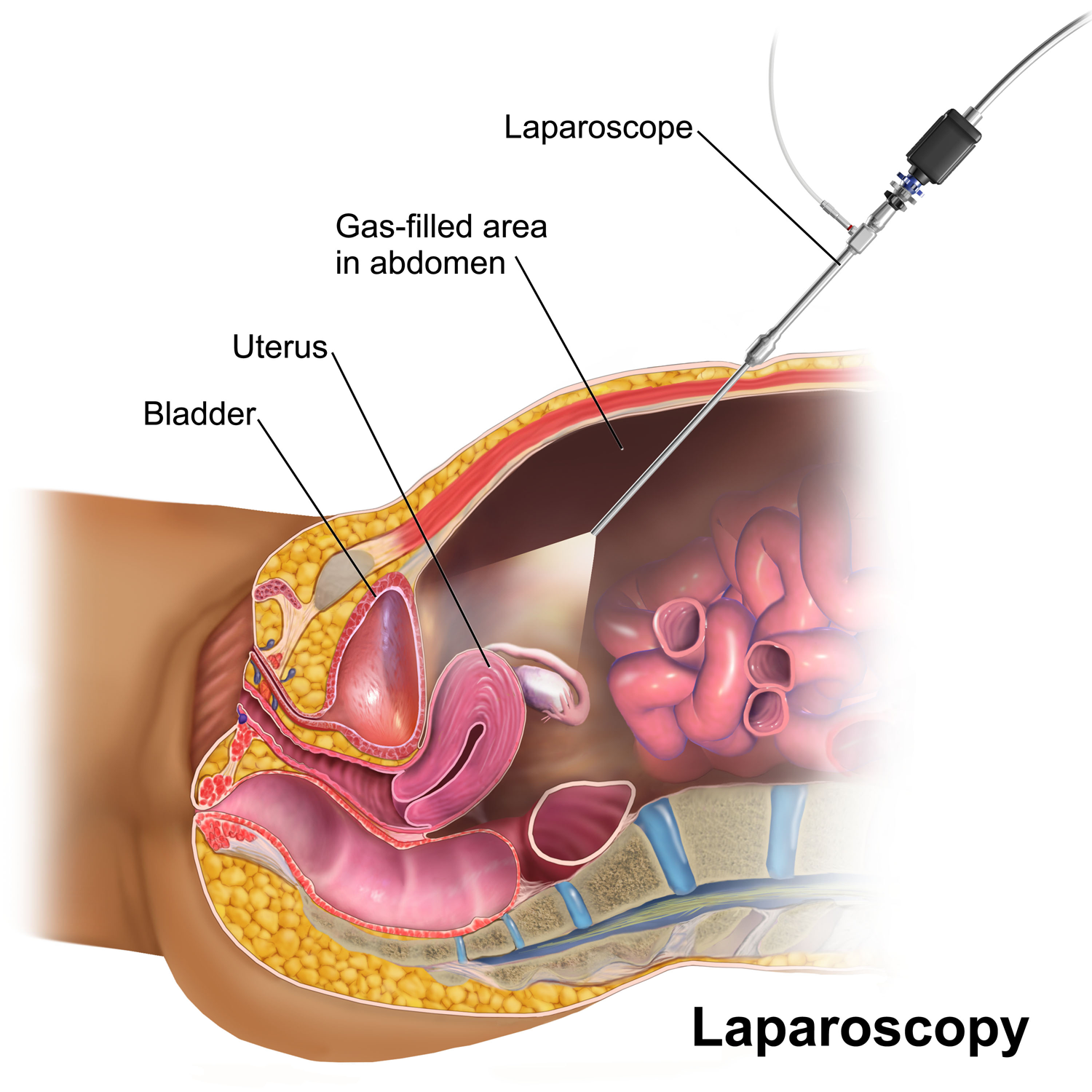 What is Laparoscopy, Its Procedure and Cost in Pakistan?