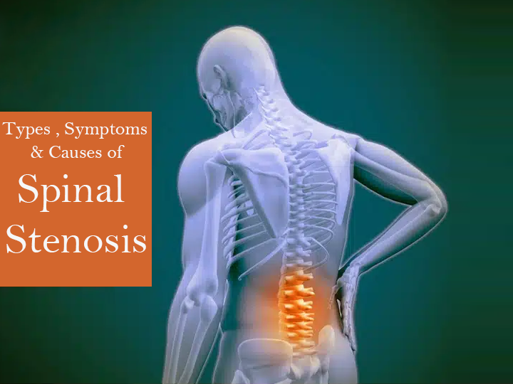 spinal-stenosis